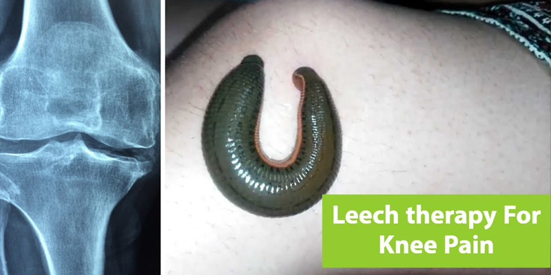 Can leech therapy cure varicose veins? – Vascular Care Expert